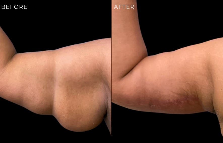Arm Lift at The Self Institute