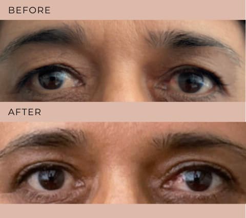 Eyelid Surgery at The Self Institute