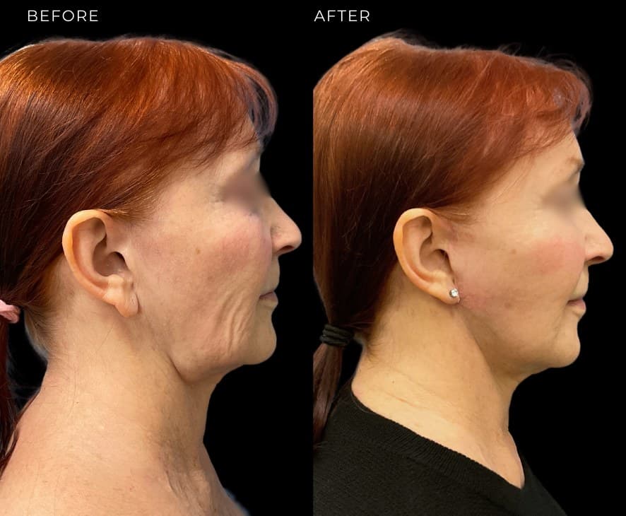 Facelift at The Self Institute