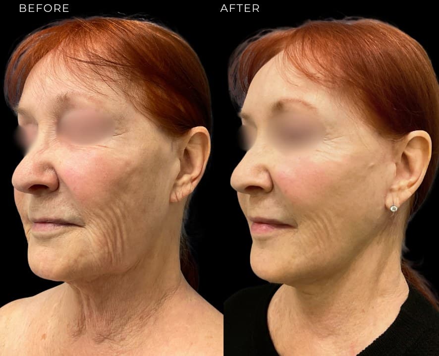 Neck Lift at The Self Institute
