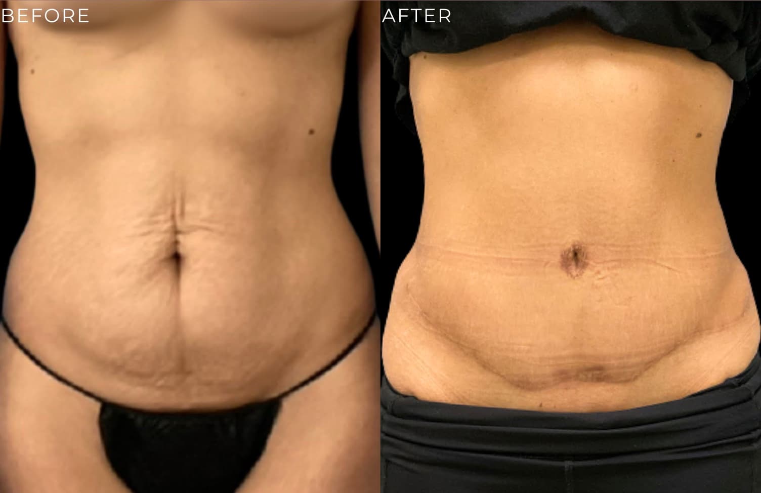 Tummy Tuck at The Self Institute