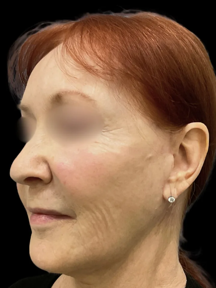 Facelift, view 4 after