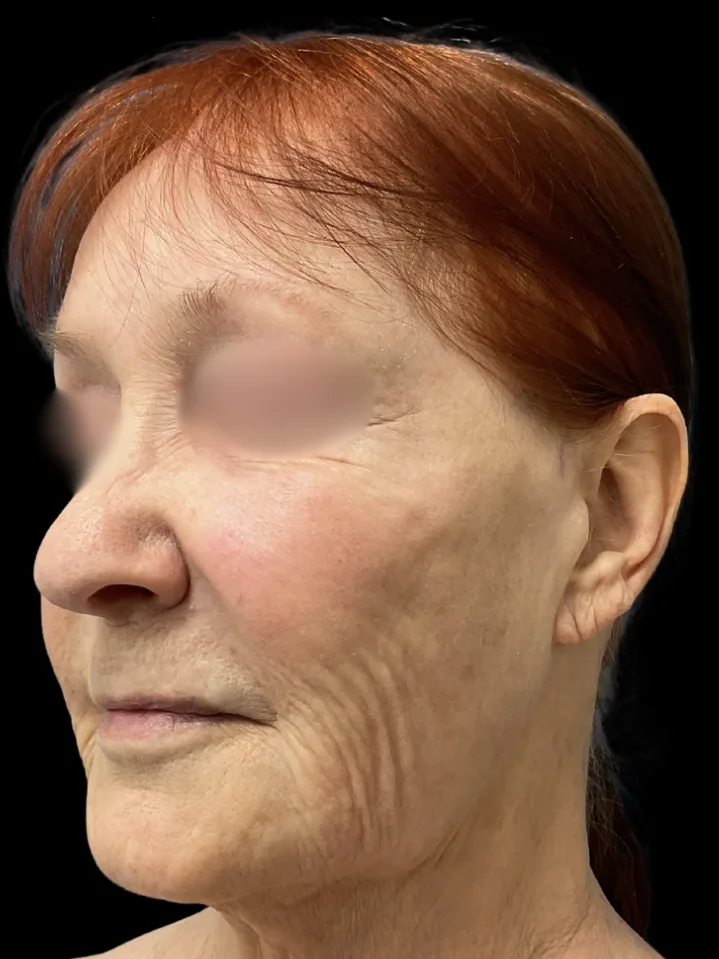 Facelift, view 4 before