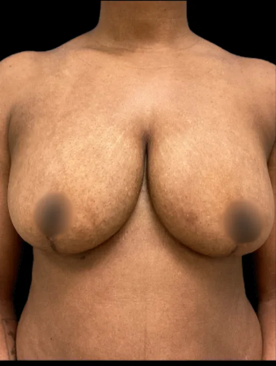Breast Reduction, view 2 after