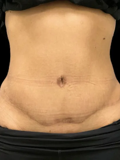 Tummy Tuck, view 1 after