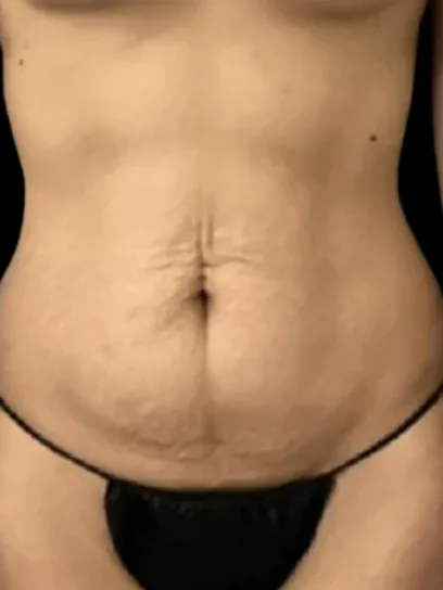 Tummy Tuck, view 1 before