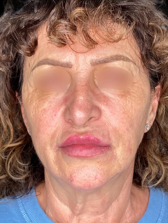 Facelift, view 3 before
