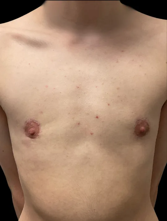 Breast Lift, view 1 after