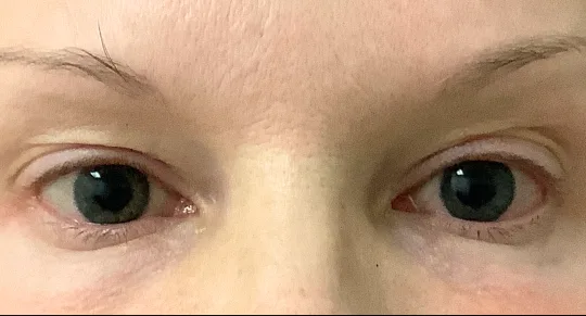 Eyelid Surgery, view 1 before