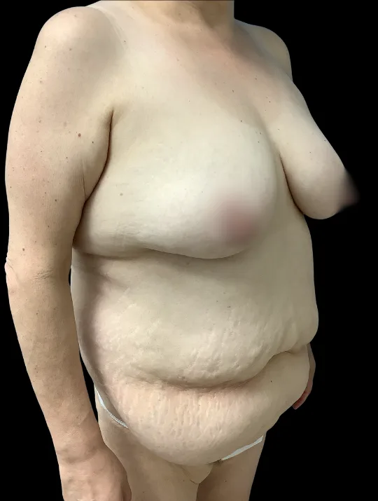 Breast Reduction, view 1 before