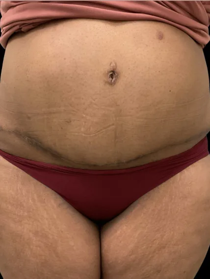 Tummy Tuck, view 2 after