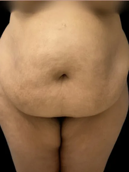 Tummy Tuck, view 2 before