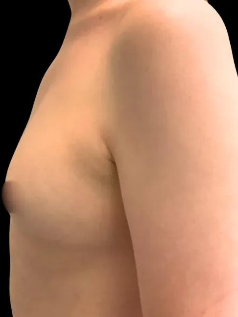 Breast Augmentation, view 1 after