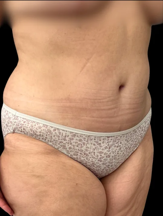 Tummy Tuck, view 4 after