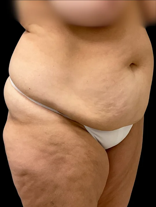 Tummy Tuck, view 4 before