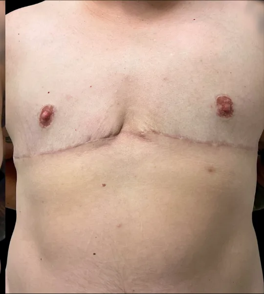 Top Surgery, view 1 after