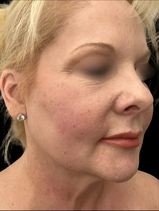 Facelift, view 2 after
