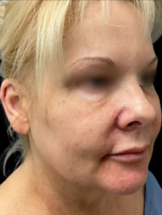 Facelift, view 2 before