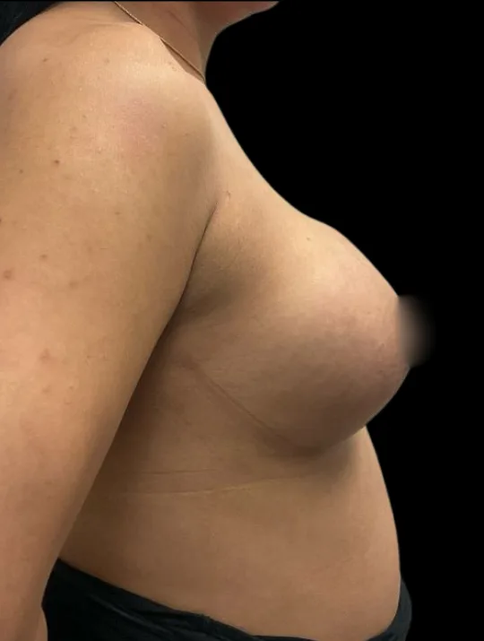 Gender Affirming Breast Augmentation, view 3 after