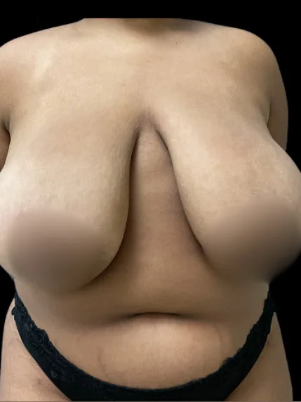 Breast Reduction, view 1 before