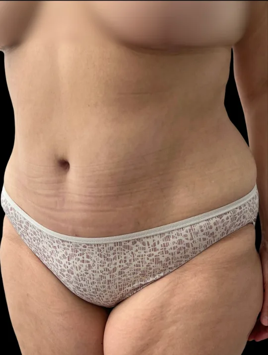 Tummy Tuck, view 1 after