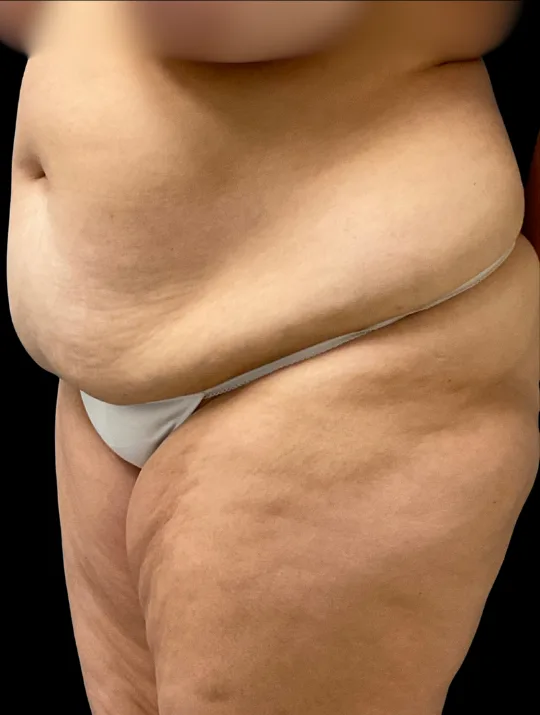 Tummy Tuck, view 1 before