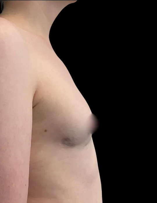 Breast Augmentation, view 1 after