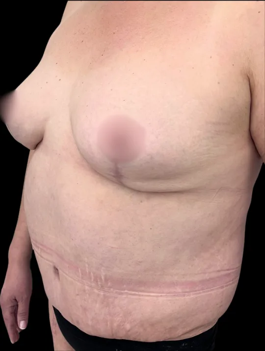 Breast Reduction, view 2 after