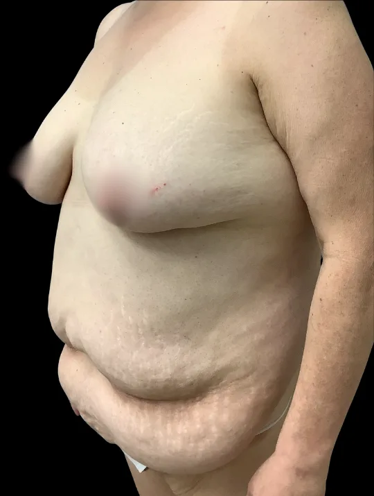 Breast Reduction, view 2 before
