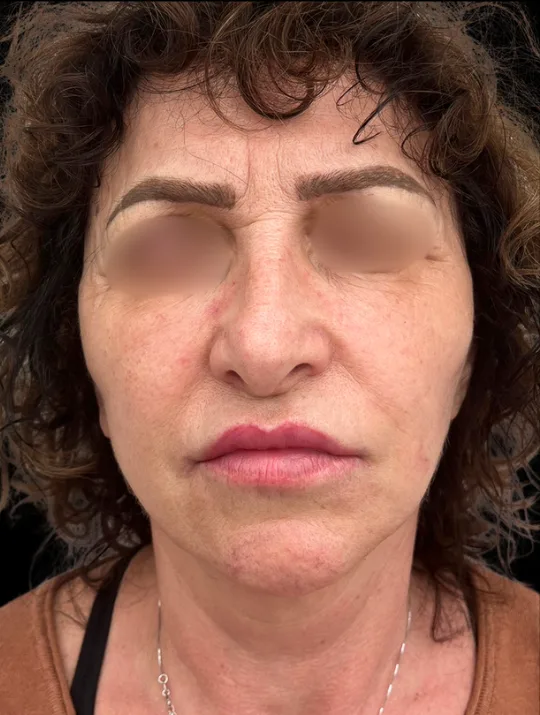 Neck Lift, view 3 after