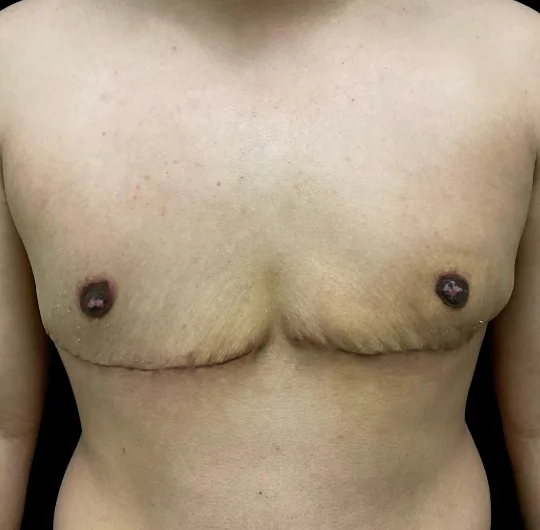 Top Surgery, view 1 after
