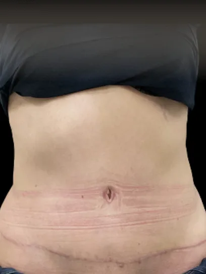 Tummy Tuck, view 1 after