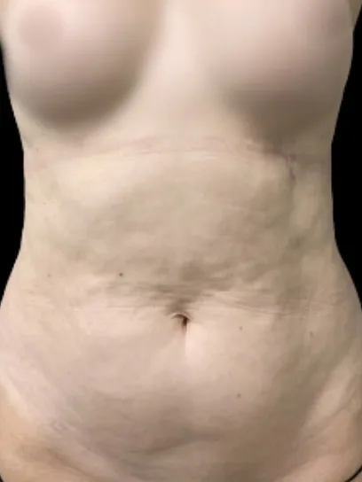 Tummy Tuck, view 1 before