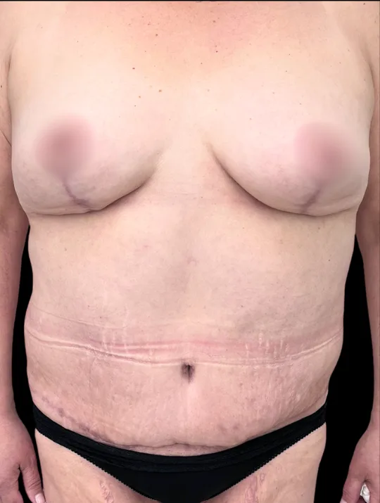 Breast Reduction (Vertical) with Tummy Tuck, after, 8 Months Post