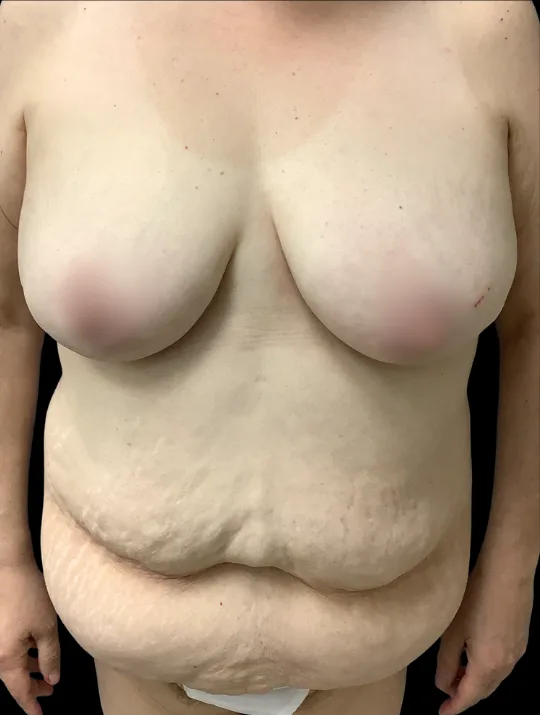 Breast Reduction (Vertical) with Tummy Tuck, before