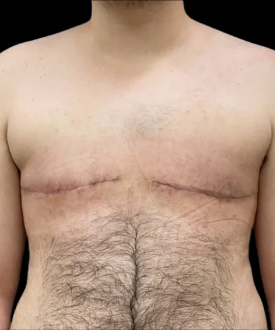 Top Surgery, view 1 after