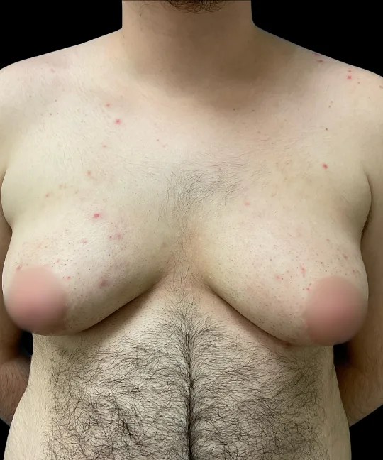 Top Surgery, view 1 before