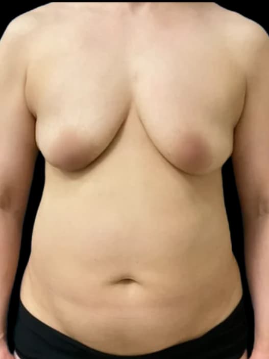 Tummy Tuck (Subfascial - 350 cc) with Breast Augmentation, before