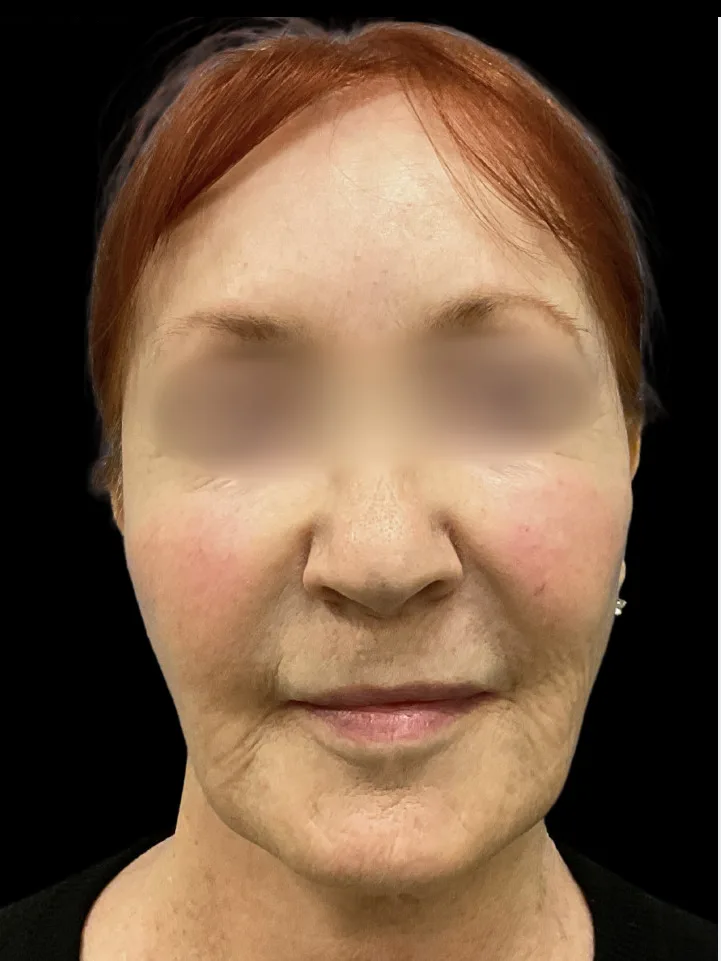 Facelift, view 1 after