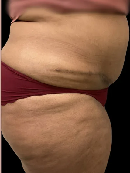 Tummy Tuck, view 1 after