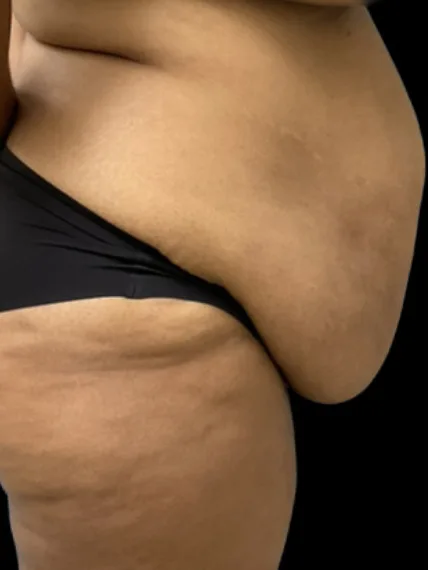 Tummy Tuck, view 1 before