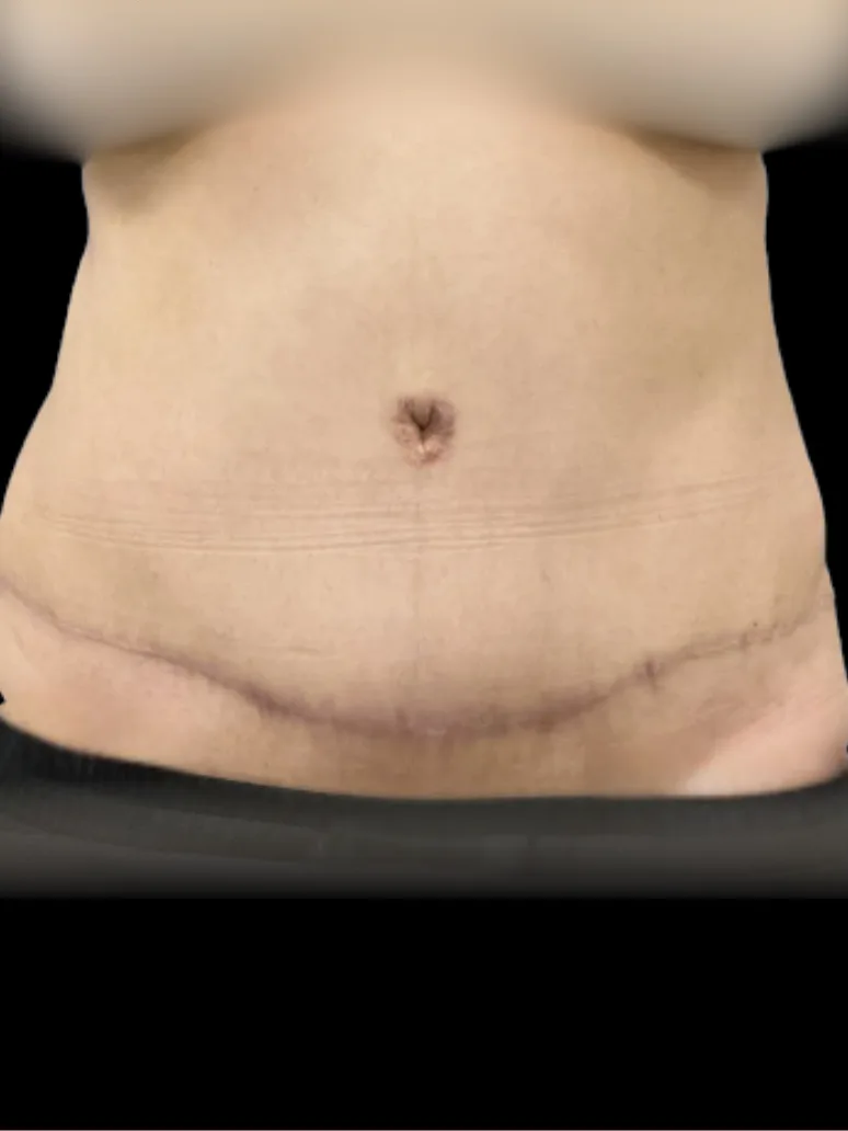 Tummy Tuck, view 1 after