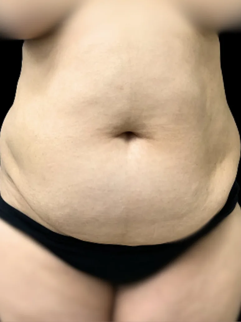 Tummy Tuck, view 1 before