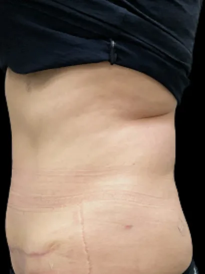 Tummy Tuck, view 1 after