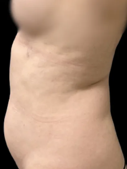 Tummy Tuck, view 1 before