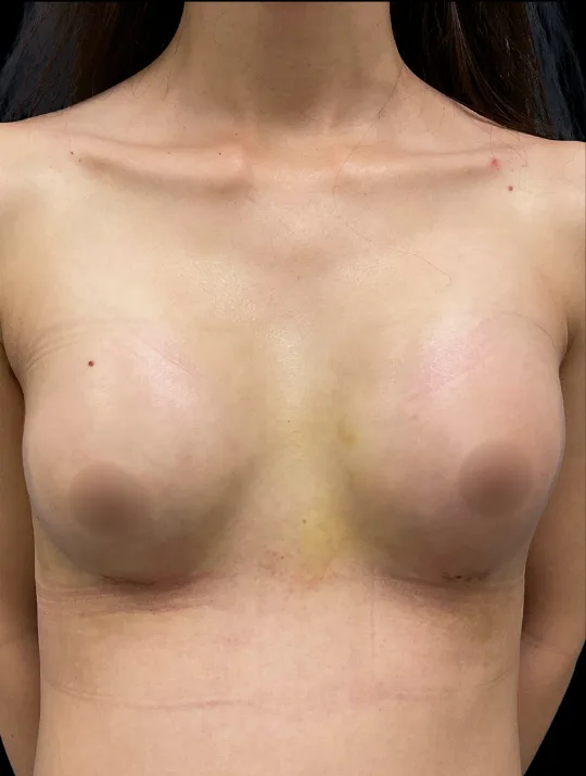 Gender Affirming Breast Augmentation, view 2 after