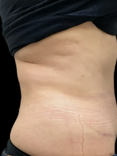 Tummy Tuck, view 1 after