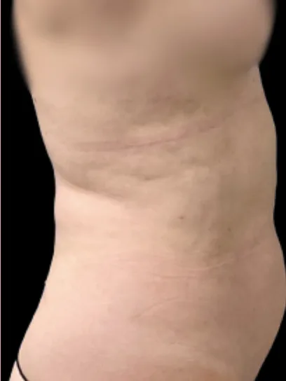 Tummy Tuck, view 1 before