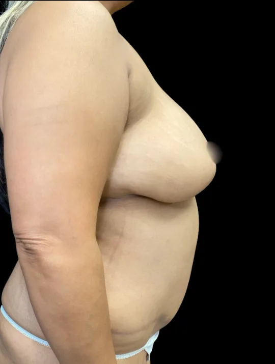 Breast Reduction, view 1 after