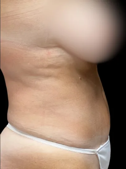Tummy Tuck, view 1 after